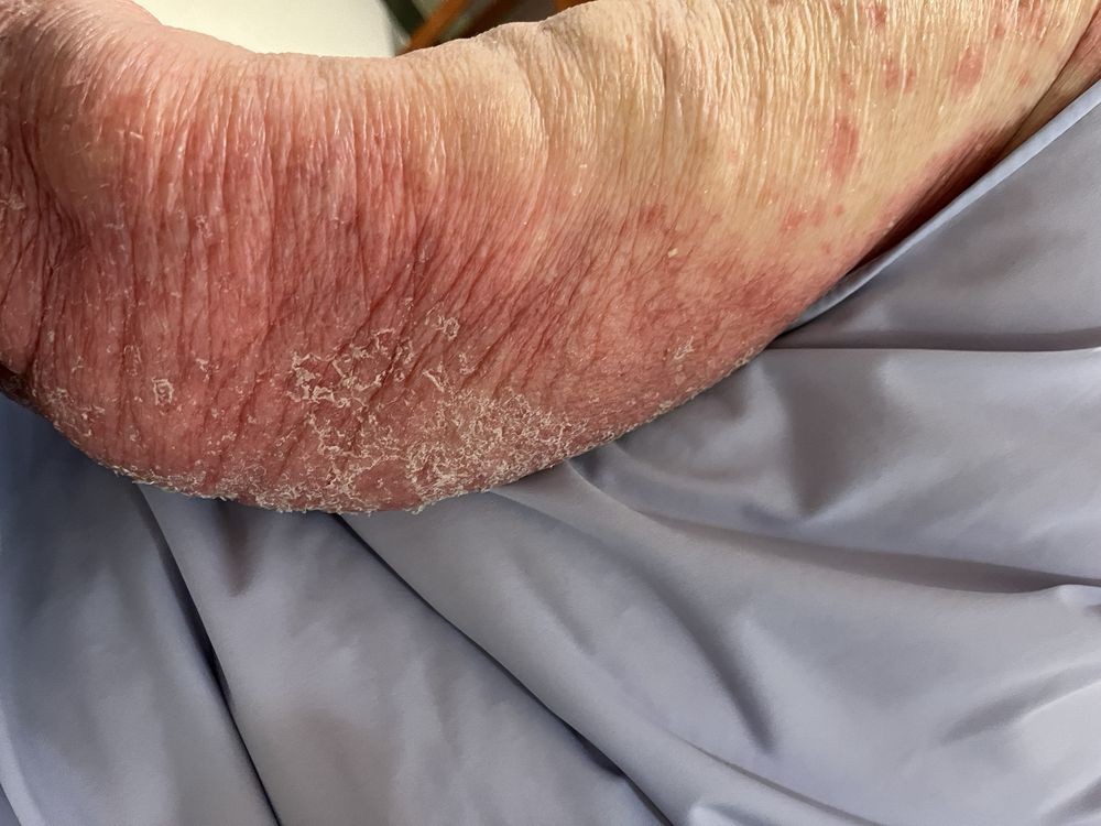 Close-up of dry and irritated skin on an arm.
