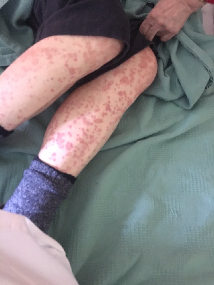Red rash covering legs, indicating a possible skin condition.
