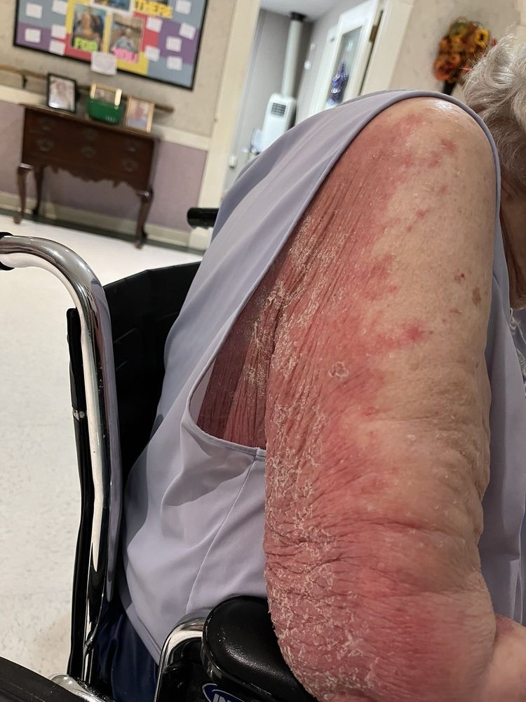 An elderly person's arm showing signs of a skin condition with redness and inflammation.