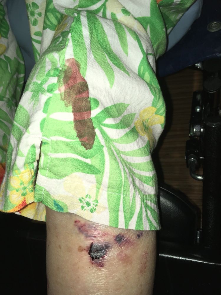 A bruised leg with a stain on floral shorts.
