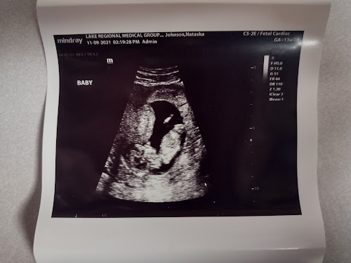 An ultrasound image showing the developing fetus.