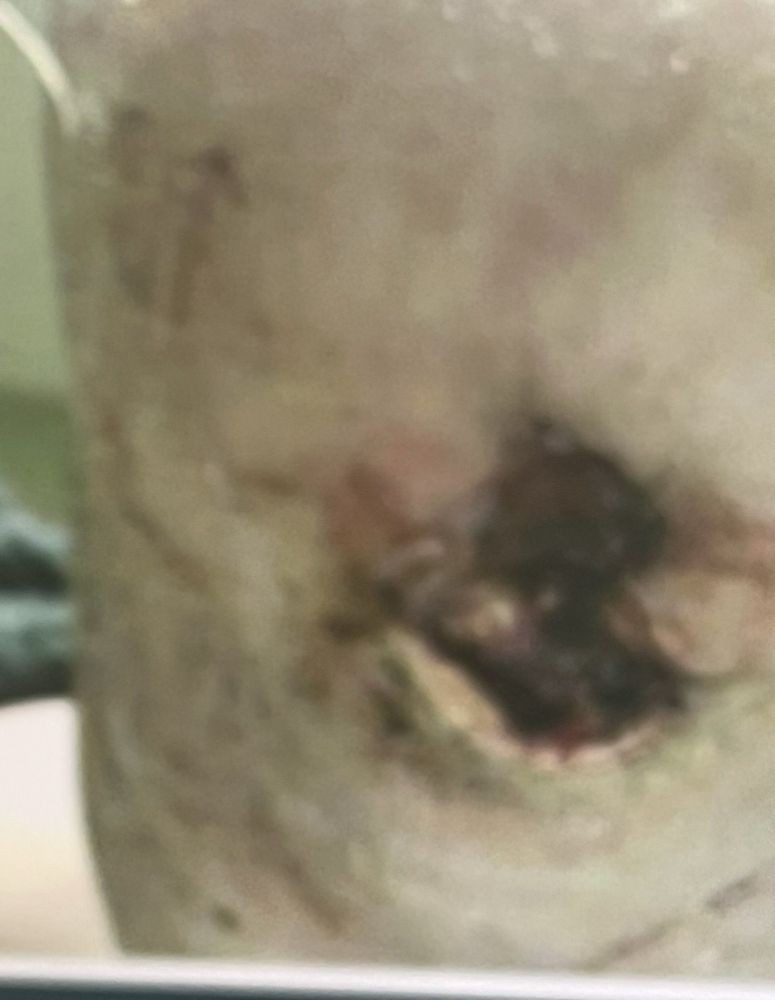Close-up of a skin wound showing signs of infection.