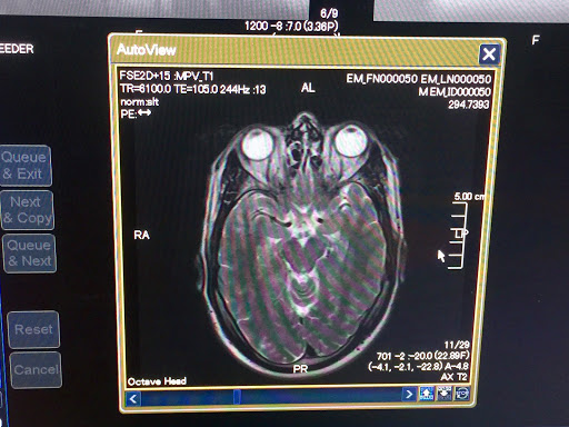 An MRI scan of a human brain showing detailed internal structures.