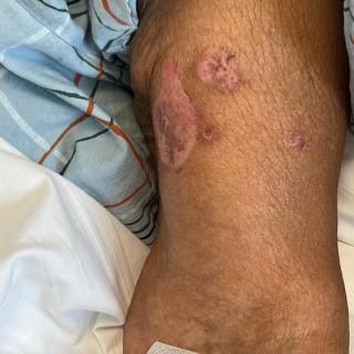 A medical image showing skin lesions on a person's leg.