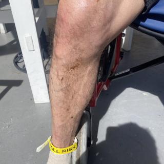 A leg with bruises and scratches while seated outdoors.