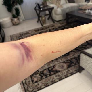 A person's arm with a visible bruise in a living room setting.