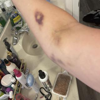 A bruised arm near a bathroom sink with various personal care items.