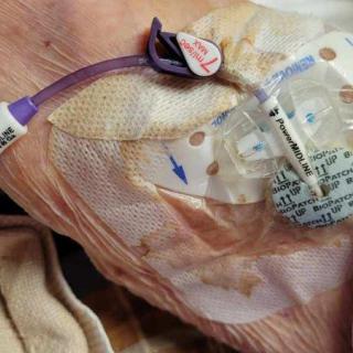 Close-up view of an intravenous (IV) line setup on a patient's arm.