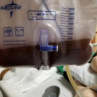 An IV bag containing a dark fluid, typically used in medical treatments.