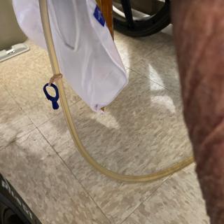 A catheter attached to a urine bag in a healthcare setting.