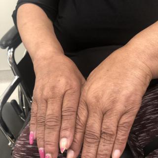 Close-up of manicured hands resting on a lap with some fingers painted pink and others natural, while sitting in a wheelchair.