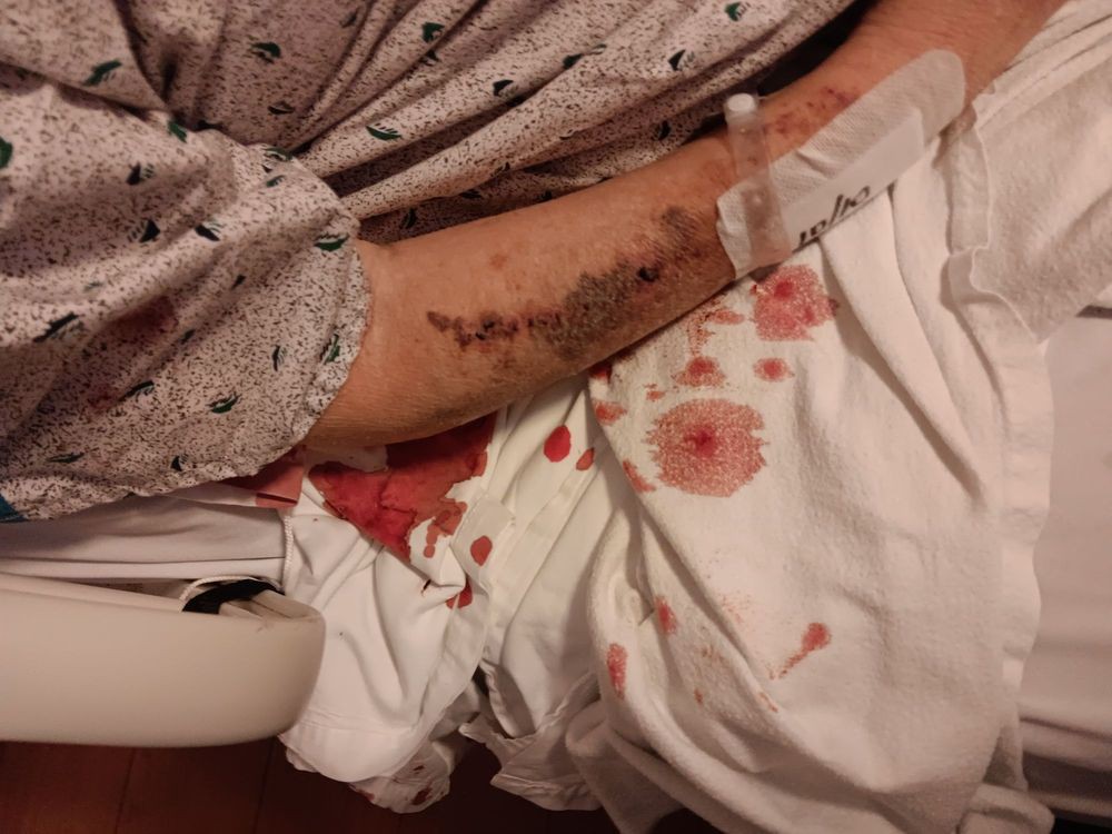 An injured arm with bandages and visible blood stains on a hospital bed.