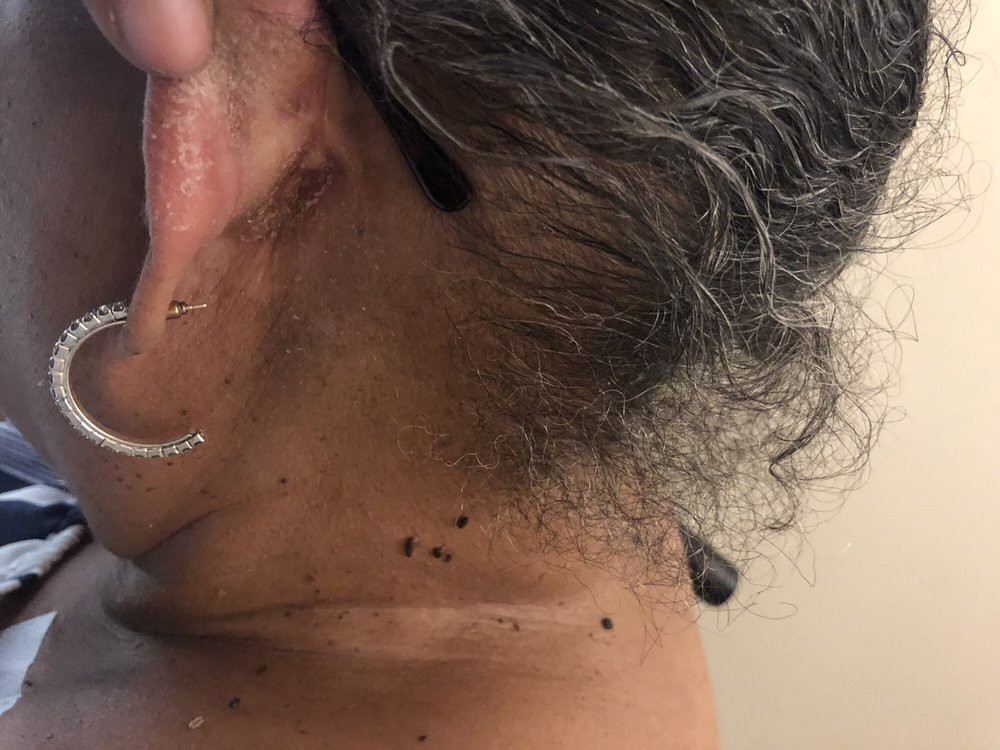 Close-up of the back of a person's neck showing moles and hair.