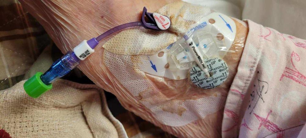 Close-up view of an intravenous (IV) line setup on a patient's arm.