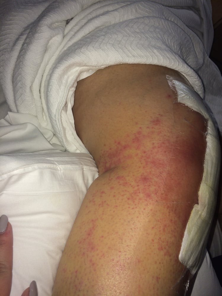An image showing a red rash or skin irritation on a person's leg.