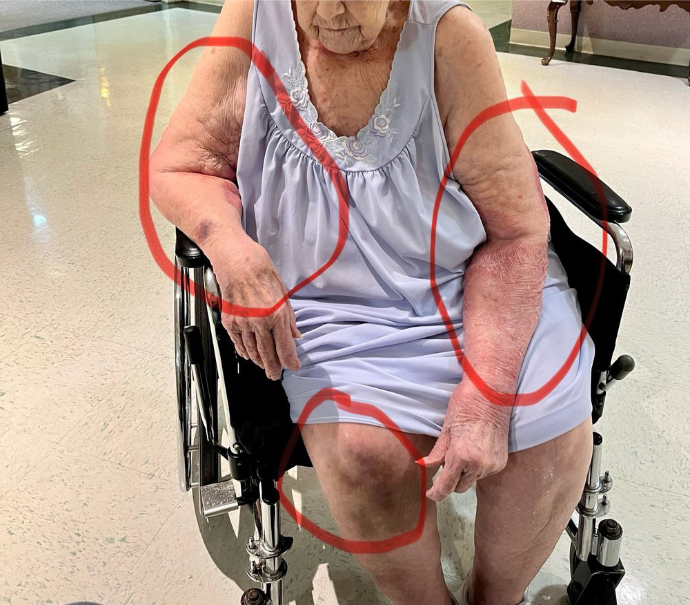 An elderly woman in a wheelchair, wearing a hospital gown, showing visible skin conditions.