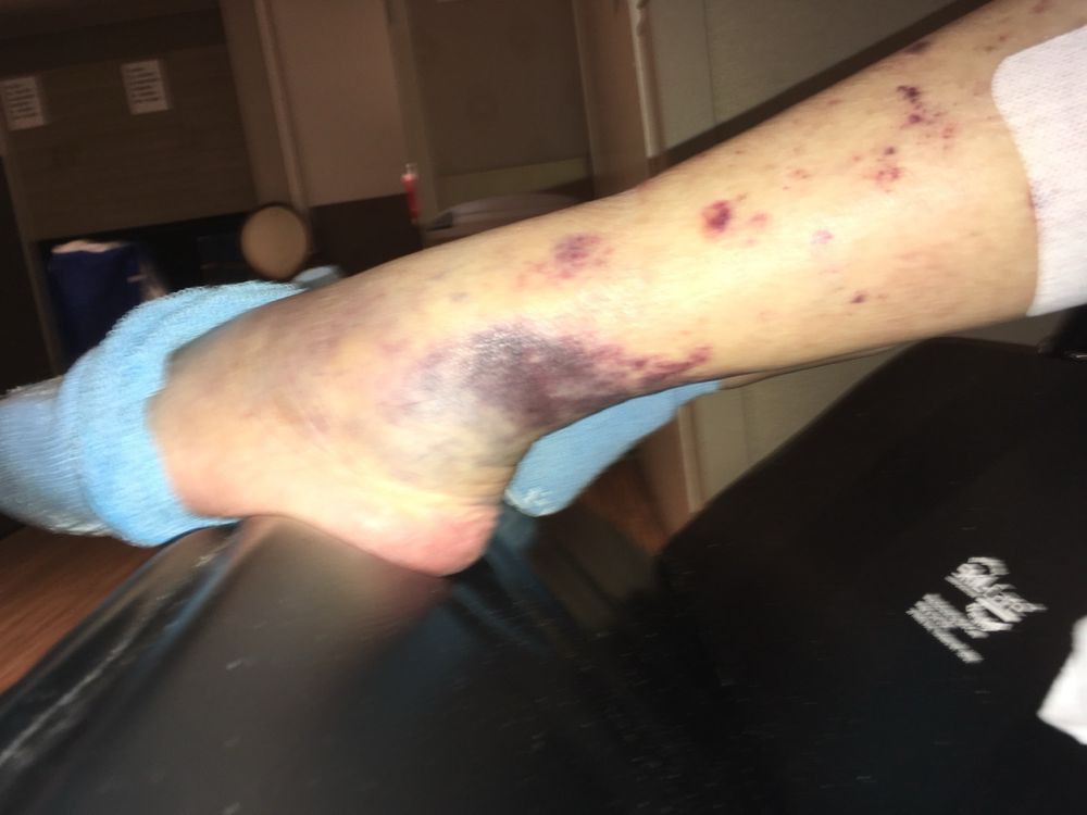A leg showing significant bruising and discoloration, indicating an injury.