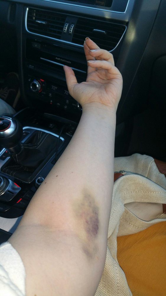 An arm with a visible bruise resting inside a car.