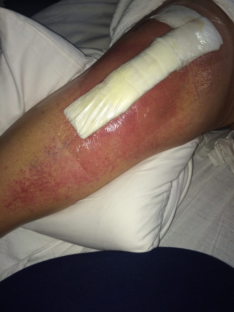Leg with a bandaged wound and surrounding redness.