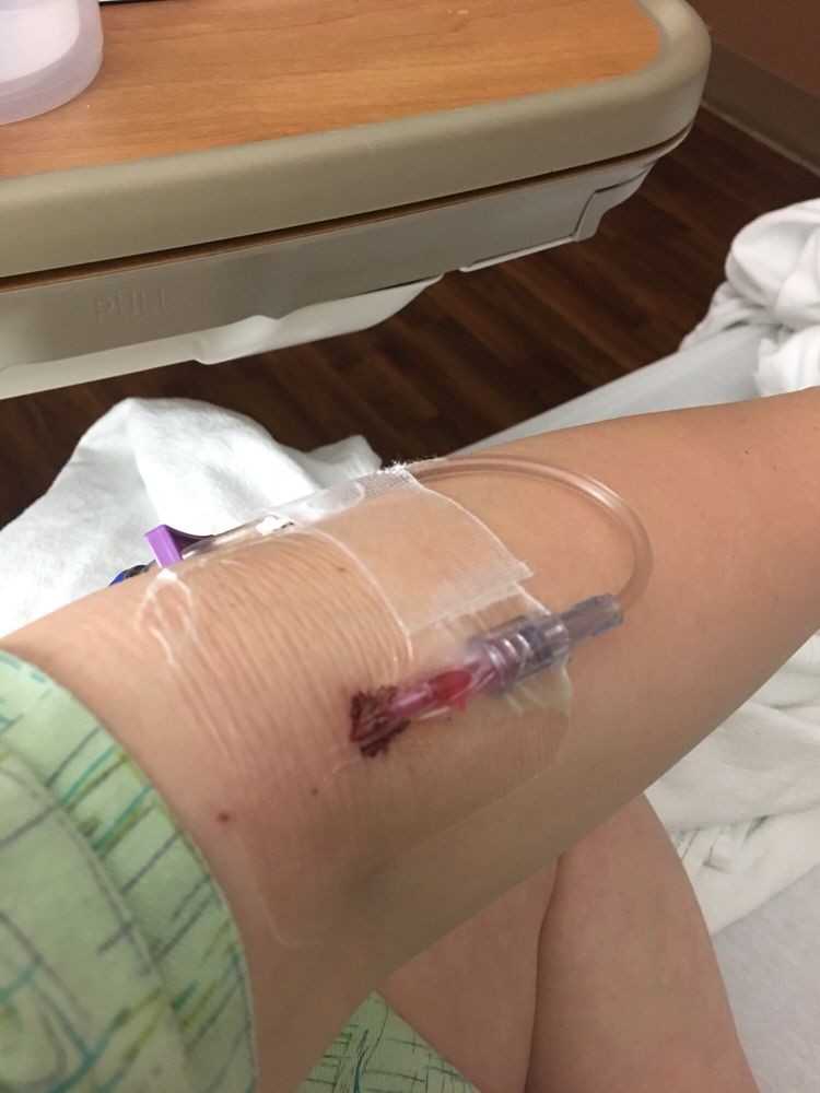 An intravenous (IV) line inserted into a patient's arm during a medical procedure.