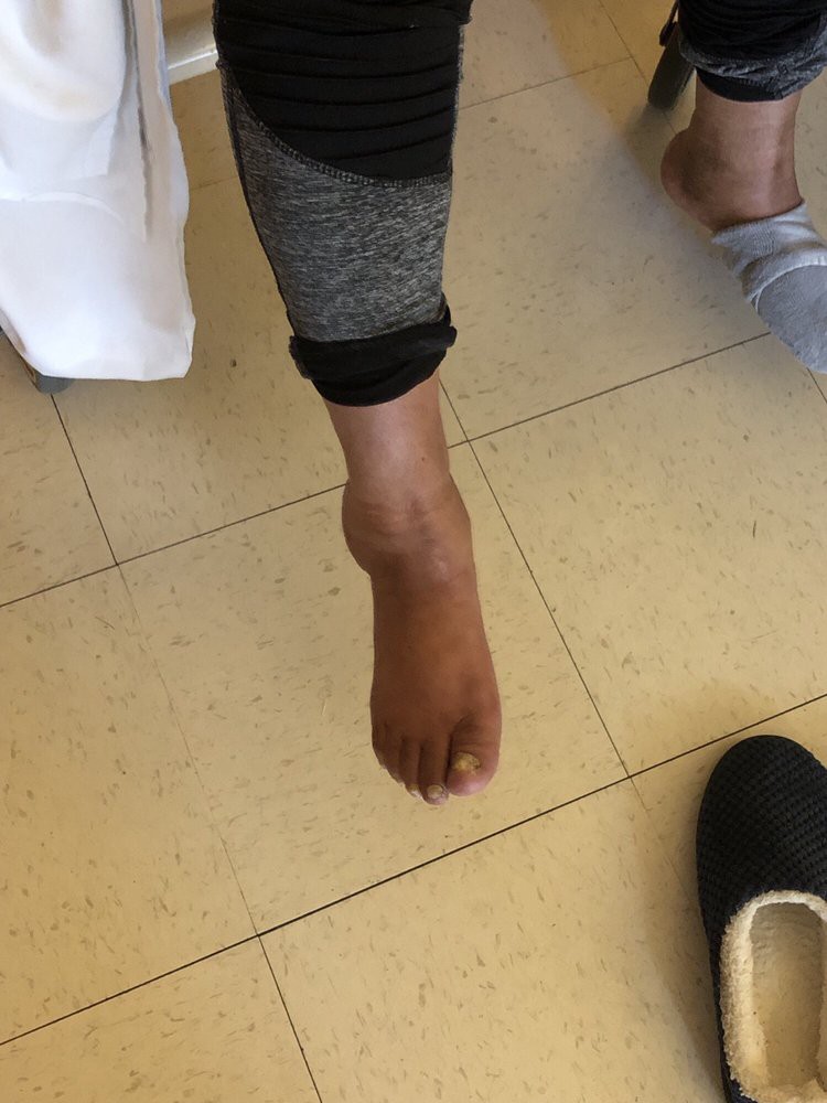 An image showing a swollen foot and ankle indoors.