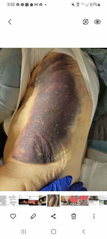 Severe bruise on the upper arm area.