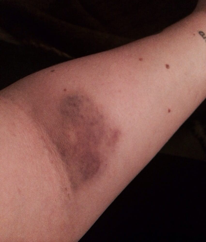 A bruise on a person's arm.
