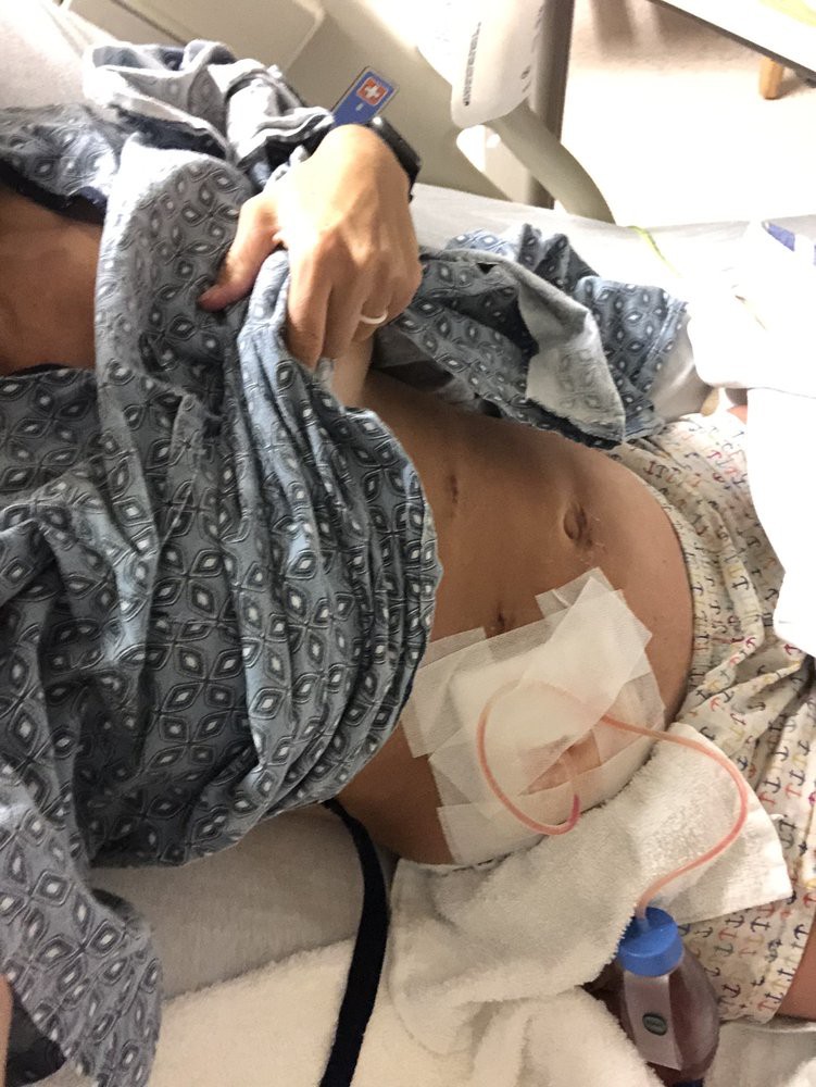 A patient in a hospital bed showing a bandaged abdomen, indicating post-surgery recovery.