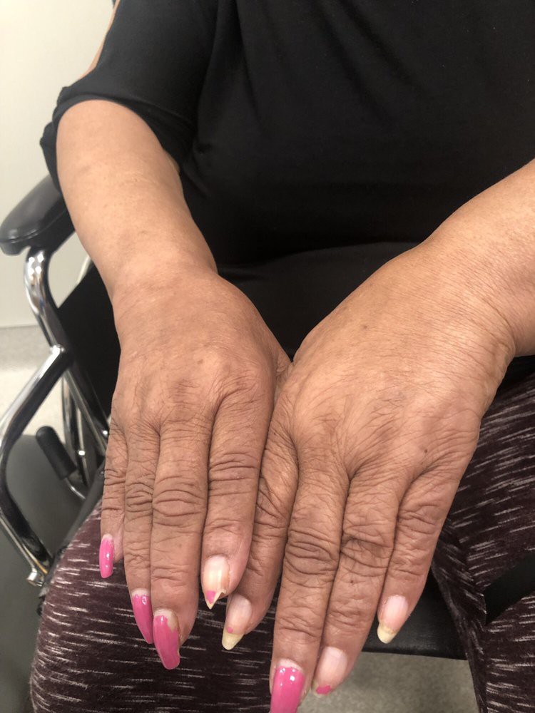 Close-up of manicured hands resting on a lap with some fingers painted pink and others natural, while sitting in a wheelchair.