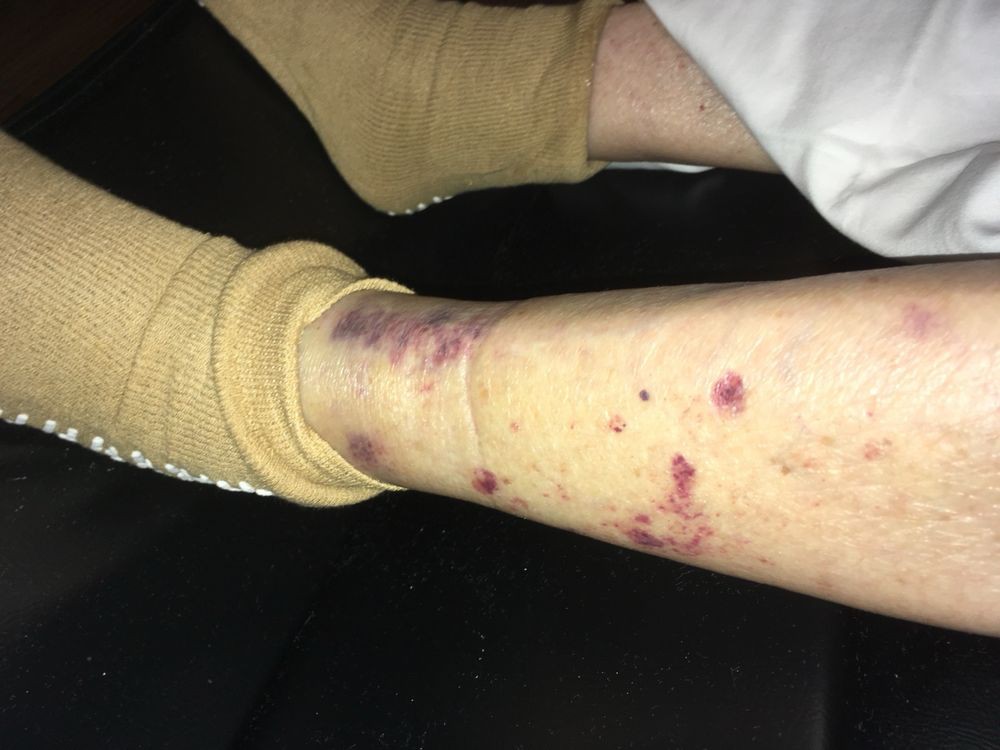 A leg displaying bruising and skin lesions, possibly indicating a medical condition.