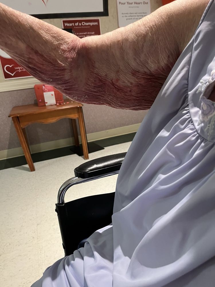 A patient in a wheelchair showing their arm in a medical setting.